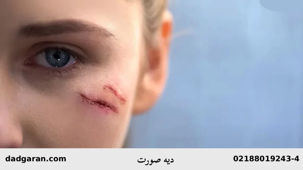 گرفتن مبلغ دیه صورت-دادگران حامی