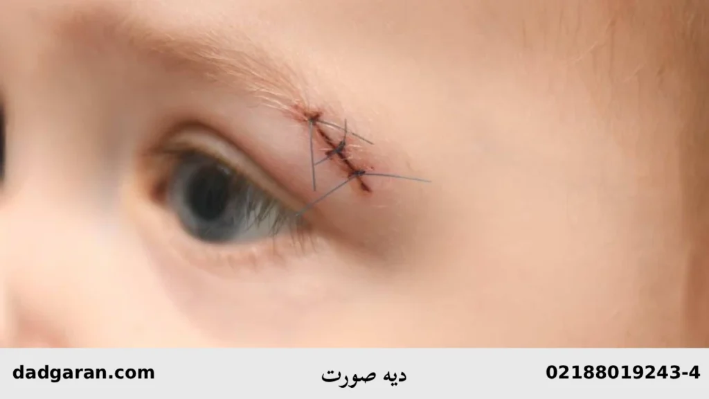 دیه زخم صورت-دادگران حامی